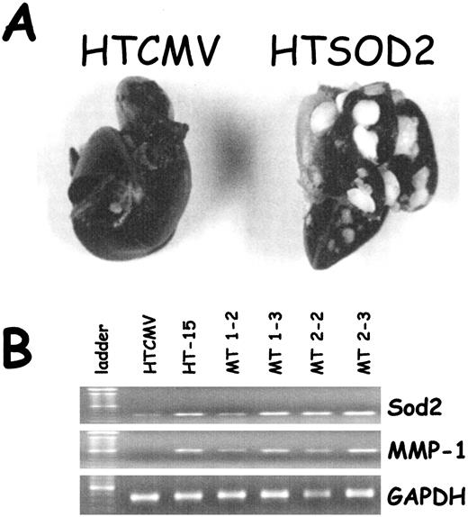 Fig. 4. In vivo analysis of Sod2-overexpressing tumor cell lines. A, Sod2 confers metastatic potential on fibrosarcoma cells. Appearance of lung metastases from mice that were given i.v. injections with a heterogeneous population of Sod2-overexpressing or HTCMV (control) cell lines. Lungs were perfused via the trachea with a 15% solution of india ink and fixed in fekete’s solution. B, RT-PCR analysis of MnSOD, MMP-1, MMP-3, and GAPDH from HTCMV and HTSod2-isolated metastatic nodules as shown in A. MT 1–2, mouse 1 nodule 2; MT 1–3, mouse 1 nodule 3; MT 2–2, mouse 2 nodule 2; MT 2–3, mouse 1 nodule 3.