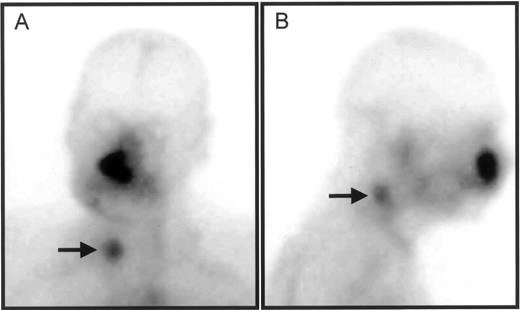 Fig. 4. Frontal (A) and lateral (B) planar image of the head and neck region of patient 16, 72 h after administration of 186Re-BIWA 4. Accumulation of radiolabeled hMAb BIWA 4 is visible in tumor recurrence in right nasal cavity, and at two cutaneous metastases in the neck (arrows).
