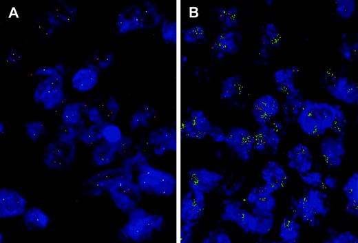 Fig. 2. Dual color FISH on NSCLC nuclei with specific HER-2/neu (green fluorescent signals) and α-satellite chromosome 17 (red fluorescent signals) probes. A, tumor section showing two normal copy of both probes. B, tumor section with a high level of HER-2/neu amplification, together with two normal spots of α-satellite chromosome 17.
