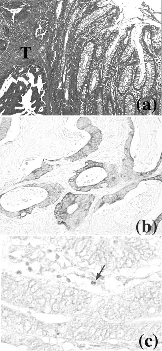 Fig. 1. Immunostains of colon cancer (Dukes’ classification C). A, hyperplastic changes in mucosa adjacent to the cancer (T; H&E stain). B, IL-15-positive staining in cancer cells. C, infiltration of tumor by a few NK cells (arrow) was detected with anti-CD56 Ab. Bar, 100 μm.