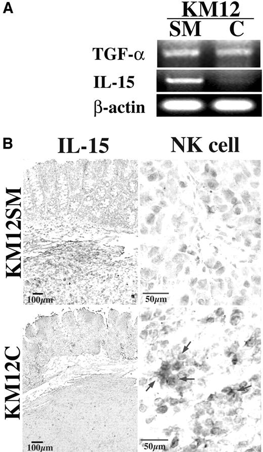 Fig. 2. A, expression of TGF-α and IL-15 mRNA by KM12SM (high metastatic potential) and KM12C (low metastatic potential) human colon cancer cells as determined by RT-PCR. β-Actin mRNA served as an internal control. B, immunostaining of human IL-15 and mouse NK cell marker (IL-15Rα) in KM12SM and KM12C tumors growing in the cecum of nude mice. Strong IL-15 immunoreactivity was found in KM12SM cells but not in KM12C cells. Few NK cells were found in the KM12SM tumor. The mucosa adjacent to the KM12SM tumor showed thickened hyperplastic changes. Arrow, IL-15Rα-positive NK cell.