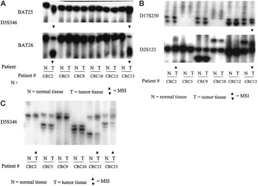 Fig. 1. MSI analysis. CRC case number 5 (CRC5) shows no MSI (MSS). CRC2 shows MSI-H with instability at BAT-25, BAT-26, D5S346, and D2S123. CRC13 shows MSI-H with instability at BAT-25, BAT-26, D2S346, D2123, and D17S250. The bands for tumors are shown by the arrow.