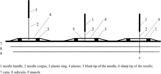 Fig. 1. Placebo-needle when touching the skin (left) and after retraction of the needle into the handle (middle), real acupuncture needle (right; Ref. 12).