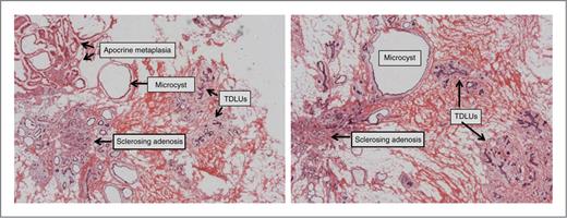 Figure 1. Hematoxylin and eosin–stained images of representative breast stroma sections from the upper outer quadrant of patient 19. The image on the left is an image from the original section; that on the right represents the final cut, taken after the intervening 240 μm were used for DNA isolation.