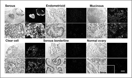 Figure 1. Expression of WNT7A in ovarian tumors, borderline, and normal ovaries. For each tissue type, representative photomicrographs of WNT7A expression are presented in dark-field illumination (right) and bright-field photomicrographs (left) for comparison of the histology for each section. Scale bar = 100 μm.