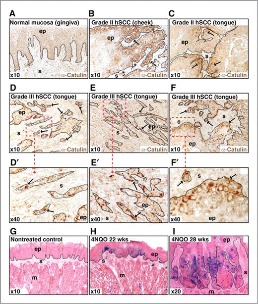 Figure 3. α-Catulin is expressed at the invasion front and in migrating cells in SCCs. A–F, immunohistochemical analyses shows α-catulin expression in a tissue array consisting of 20 cases of hHNSCCs and 6 normal oral mucosa epithelium. Tissue origin and tumor grade, as provided by the manufacturer, is indicated. A–F, representative images are shown. Asterisks point out the migrating, metastatic tumor cells. There is minimal α-catulin expression in the normal epithelium (A), when compared with the HNSCCs (B–F). D′–F′, selected regions from higher grade SCCs are magnified. G–I, mice expressing the β-galactosidase reporter under endogenous α-catulin promoter were given drinking water containing 4NQO for 16 weeks to induce oral SCC (25). Mice were examined 22 (H) and 28 weeks (I) after initial 4NQO administration. 4NQO-induced SCC lesions formed on the tongues compared with untreated controls (G), with higher grade dysplasia at 28 weeks, reflecting the carcinogenic progression. Analyzing frozen tongue sections and staining with X-Gal show α-catulin expressed at the invasion front of migrating SCCs. Magnification is as indicated. ep, epithelium; m, muscle; s, stroma.