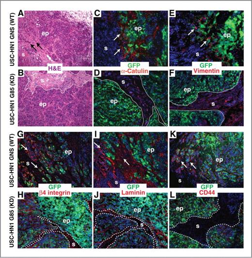 Figure 6. α-Catulin–ablated hSCC cells are unable to rearrange ECM components to migrate and invade in vivo. We analyzed the tumors that formed from the injection of α-catulin–deficient and control hSCC cell lines, where tGFP expression marks the transduced cancer cells. A and B, hematoxylin and eosin (H&E) staining of the tumors allow for visualization of the general tumor morphology. C–L, immunofluorescent staining of frozen sections of the tumors that formed from the injection of control (wild-type, WT) and α-catulin–deficient (knockdown, KD) hSCC cell lines with antibodies as indicated. Arrows indicate invasive tumor fronts in control tumors, whereas dashed lines indicate less invasive tumor margins in α-catulin–deficient tumors. ep, epithelium; s, stroma.