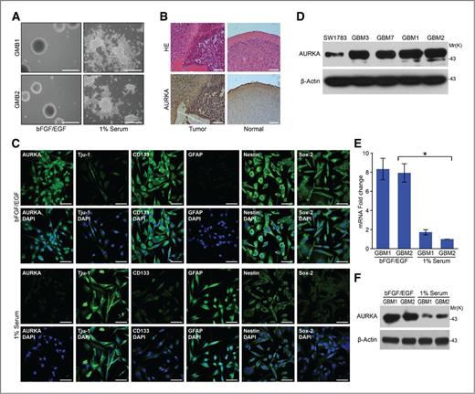 Figure 1. AURKA expression in GICs. A, left, neurosphere formation of two primary glioblastoma specimens derived from GICs cultured in bFGF/EGF-containing stem cell medium; right, morphologic changes of GICs after 1% serum was added for 2 weeks. Bars represent 100 μmol/L. B, the mouse brain was fixed in 4% formaldehyde and embedded in paraffin. Tumor formation was determined by the histologic analysis of H&E-stained sections, and AURKA expression was detected by immunohistochemical staining. × 100 magnification. C, dissociated GIC cells from neurospheres were plated on coverslips that were precoated with poly-L-ornithine and fibronectin, and the indicated neural precursor/differentiation markers were examined by immunofluorescence (scale bar, 50 μmol/L) before and after 1% serum induction. D, the AURKA protein expression levels were detected by Western blotting in SW1783 and 4 GIC cell lines. E, mRNA levels of AURKA in 2 GICs before and after serum addition were detected by real-time reverse transcriptase PCR. SDs are from 3 independent experiments, *, P < 0.001. F, AURKA protein levels were detected by Western blot analysis before and after 1% serum induction in GBM1 and GBM2 cells.