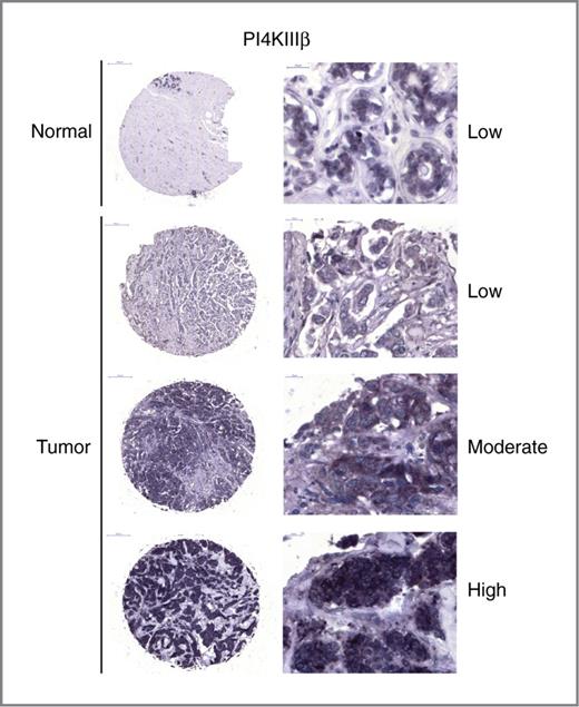 Figure 1. PI4KIIIβ expression in primary breast tumors in a TMA. Representative images of PI4KIIIβ immunostaining in normal breast tissue and breast tumors classified as showing low, moderate, or high expression of PI4KIIIβ. Scale bars, 100 μm.