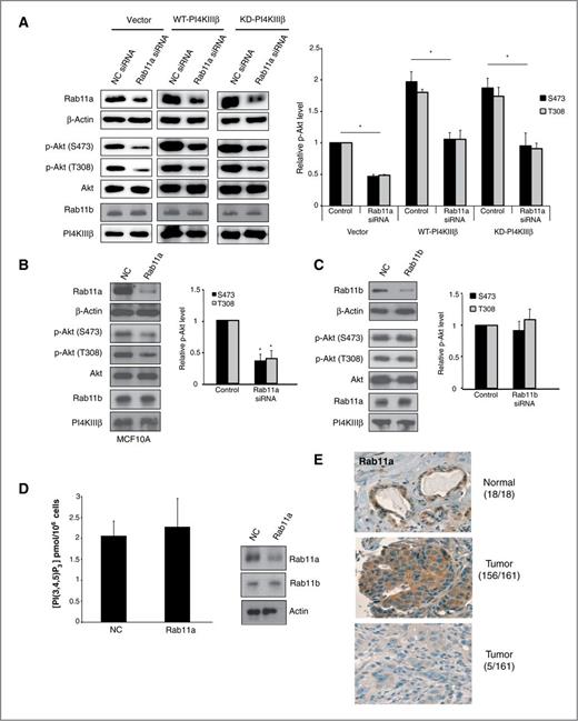 Figure 8. Rab11a is implicated in PI4KIIIβ mediated Akt activation. A, left, siRNA depletion of Rab11a decreases AKT activation in WT-PI4KIIIβ–overexpressing and KD-PI4KIIIβ–expressing BT549 cells as compared with cells treated with the negative control siRNA. Right, relative decrease in Akt phosphorylation in cells treated with siRNA targeted to Rab11 as compared with cells treated with negative control siRNA. Data, mean ± SE of the mean of three independent trials; statistical significance: *, P < 0.05 (Student t test). B, left, siRNA depletion of Rab11a decreases AKT activation in WT-PI4KIIIβ–overexpressing MCF10A cells as compared with cells treated with the negative control siRNA. Right, relative decrease in Akt phosphorylation in cells treated with siRNA targeted to Rab11a as compared with cells treated with negative control siRNA. Data, mean ± SE of the mean of three independent trials; statistical significance: *, P < 0.05 (Student t test). C, left, siRNA depletion of Rab11b has no effect on AKT activation in WT-PI4KIIIβ–overexpressing BT549 cells as compared with cells treated with the negative control siRNA. Right, relative decrease in Akt phosphorylation in presented as mean ± SE of the mean of three independent trials. D, (A) PI(3,4,5)P3 abundance is shown as a concentration of pmol per 106 cells and is the mean ± SE of the mean of two independent experiments for BT549 PI4KIIIβ-overexpressing BT549 cell lines with reduced Rab11a expression. E, expression of Rab11a protein in normal human breast samples and infiltrating ductal carcinomas.