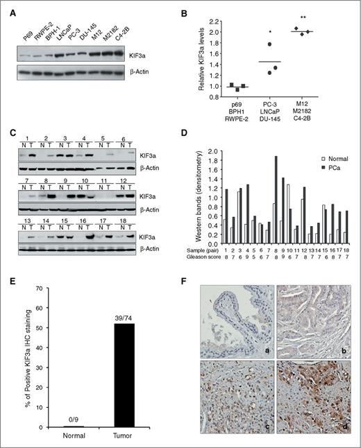 Figure 1. KIF3a is upregulated in prostate cancer (PCa). A and B, KIF3a levels in PCa cell lines were determined by Western blotting and by densitometry analysis of the Western bands. The intensity of the KIF3a bands was normalized to the intensity of their respective β-actin bands and quantified against each other. *, P < 0.05 and **, P < 0.01 as compared with benign prostate epithelial cell lines. C and D, KIF3a levels were determined in 18 paired prostate tumors and matched normal prostate tissues by Western blotting and by quantification of the protein bands as described in A and B. E, the histogram shows the percentage of positive IHC staining of KIF3a in 9 normal and 74 PCa tissues samples. The IHC staining of a prostate tissue microarray was performed with a KIF3a antibody. F, representative microphotographs of IHC analysis of KIF3a in the prostate tissue microarray. Images a to d represent IHC staining in normal prostate and grade 1–3 PCa tissues (magnification, ×200).