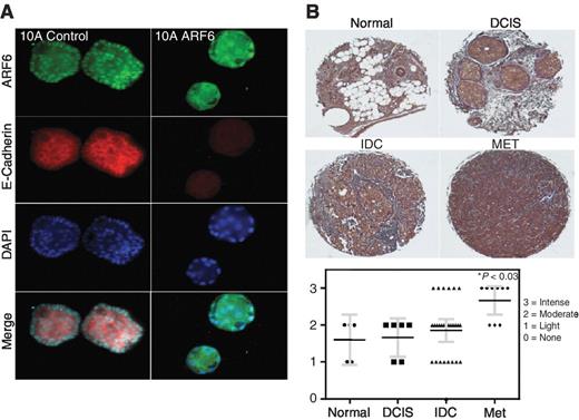 Figure 4. The miR-145 target ARF6 is overexpressed in lymph node metastasis. A, 3D cell culture of MCF-10A cells stably infected with ARF6. Cells are grown in EGF supplemented media (10 ng/mL) for 7 days followed by fixation and staining with ARF6 and E-cadherin antibodies followed by DAPI counterstaining. Acinii were examined via confocal microscopy. B, IHC for ARF6 was performed on a TMA of matched normal and breast tumor tissue, including matched primary and lymph node metastasis core samples. Normal tissue n = 5, DCIS n = 6, IDC n = 26, MET n = 9.