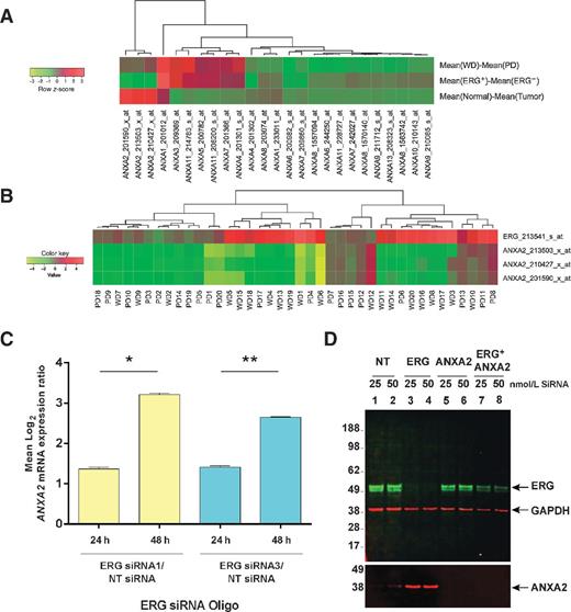 Figure 1. Gene expression analysis of 40 patients (20 WD and 20 PD) showed inverse correlation of gene expression between ERG and ANXA2. Mean differences of mRNA expression between WD and PD, ERG(+) and ERG(−), as well as normal and tumor samples for members of the ANNEXIN family (A). Tumor versus normal expression ratios of ERG and ANXA2 in 20 WD and 20 PD tumors showed an inverse correlation (B). Results from GeneChip analysis of VCaP cells, 24 and 48 hours after ERG siRNA knockdown showing ratios of ANXA2 expression for ERG/NT siRNA, averaged from three ANXA2 probe sets, 213503_x_at, 201590_x_at and 210427_x_at (two-tailed Student t test, *, P = 6.38 × 10−6; **, P = 4.51 × 10−5; C). Immunoblot assay of lysates from VCaP cells 72 hours after transfection with 25 or 50 nmol/L of ERG, ANXA2, or combined ERG and ANXA2 siRNA oligos (D).