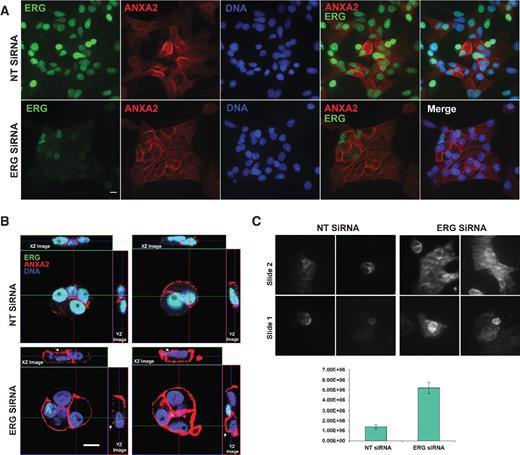 Figure 3. ERG knockdown induces ANXA2 overexpression. VCaP cells were transfected with 50 nmol/L of ERG, ANXA2, or combined ERG and ANXA2 siRNA oligos and analyzed after 72 hours by immunofluorescence assay (A). XZ- and YZ-sections, taken through the region depicted by the green and red lines, respectively, show that ERG siRNA knockdown induces accumulation of ANXA2 at the apical surface of VCaP cells (white arrowhead) compared with control NT siRNA (B). Images of TIRF field showing control and ERG siRNA knockdown cells. Signal intensity is averaged from four sets of 15 cells each (unpaired t test; n = 4 sets of 15 cells each; P = 0.032; C). All bars represent 10 μm.