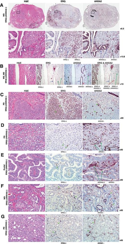 Figure 5. IHC staining of consecutive sections of representative whole-mounted prostate sections with H&E, ERG and ANXA2 antibodies demonstrate the inverse correlation of ERG and ANXA2 in prostate adenocarcinoma. A, a representative whole-mounted prostate section with index tumor of ERG(+)/ANXA2(−) phenotype. In the second row, the region indicated by the rectangle is magnified, showing membranous and cytoplasmic staining of ANXA2 in the luminal and basal cells of benign prostate epithelium (blue arrows). Black arrows indicate WD ERG(+)/ANXA2(−) cells. B, WD tumors with both ERG(+)/ANXA2(−) (black arrows) and ERG(−)/ANXA2(−) (red arrow) phenotype. Blue arrow indicates benign gland. C and D, PD tumors with inversely correlated ERG(+)/ANXA2(−) and ERG(−)/ANXA2(+) phenotype, respectively. E, prostatic ductal adenocarcinoma (papillary variant) that is ERG(−) but has both ANXA2(−) and ANXA2(+) cells. WD and PD tumors of ERG(−)/ANXA2(−) phenotype are represented in F and G, respectively. Benign glands (blue arrows) and endothelial cells (green arrowheads) are ANXA2(+).