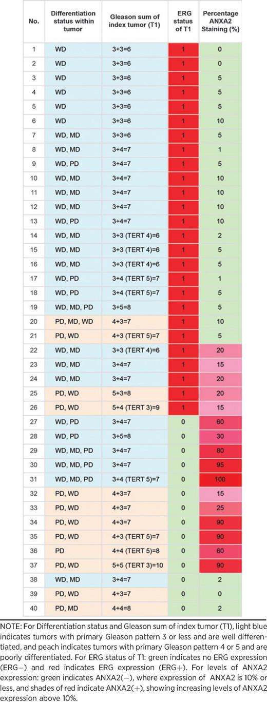ERG and ANXA2 expression in 40 patients of defined tumor differentiation status
