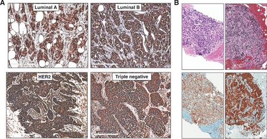 Figure 1. CX3CR1 is expressed in primary and metastatic breast cancer. A, tissues from the four main subtypes of breast adenocarcinoma: luminal A (LUM A; 7 specimens), luminal B (LUM B; 7 specimens), HER2 positive (HER2; 7 specimens), and triple negative (TN; 8 specimens) stained all positive for CX3CR1 expression. B, two representative images of a total of seven biopsy specimens of skeletal metastatic tumors that were collected from different breast cancer patients and also stained all positive for CX3CR1. Top, hematoxylin and eosin staining is shown. Magnification, 100–200×. Scale bar, 50 μm.