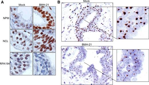 Figure 3. Suppression of 5′ETS/45S CISH signal after BMH-21 treatment of prostate tissue slices. Tissue slices were treated with either vehicle or BMH-21 (2 μmol/L) for 24 hours, and fixed. A, Staining of tissue slices for nucleolar markers NPM, NCL, and RPA194. B, CISH for 5′ETS/45S was performed on tissues after fixing in formalin and paraffin embedding. Note marked reduction in CISH signals after BMH-21 treatment. Original magnifications, x400; insets represent 2.8-fold magnifications.