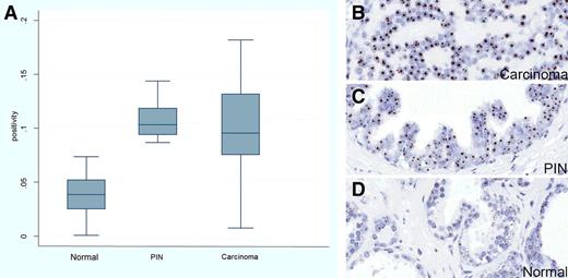 Figure 4. 5′ETS/45S CISH in human prostate whole tissue sections. A, Left plot shows box plot results of quantification of (D) normal, (C) high-grade PIN, and (B) carcinoma regions (n = 30). Original magnifications, x200. Boxes are bounded by 25th and 75th percentiles, with median shown as line. Whiskers are 2x the interquartile range, and outliers are shown as individual data points. Y-axis shows the ratio of the area of positive pixels over the area of total nuclear pixels (positivity).