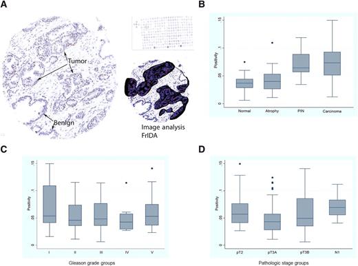 Figure 5. 5′ETS/45S CISH signals in TMA spots and quantification of region with FrIDA software. A, Image on left shows representative tumor spot, and top right shows the whole TMA section at very low power. Region of interest in this TMA spot (tumor) is highlighted by the black area mask, and the nucleolar 5′ETS/45S CISH signal mask is highlighted in red. Nuclei are highlighted in the blue mask. B, Box plot of quantified staining data from indicated diagnostic categories showing marked increase in PIN and carcinoma. Bottom plots (C and D) show that signals were not quantitatively different across different Gleason score and pathologic stages.