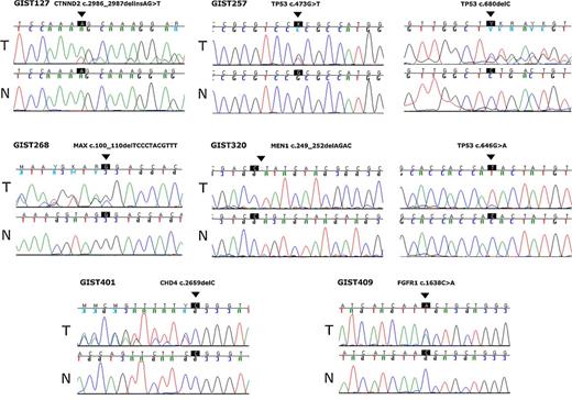 Figure 3. Somatic mutations identified in quadruple WT GIST. All relevant somatic mutations were validated by Sanger sequencing and chromatograms obtained from tumor (T) and its normal counterpart (N) are shown.