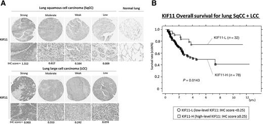Figure 4. A, Representative examples of KIF11 protein expression in lung squamous cell carcinoma (SqCC) and large cell carcinoma (LCC). Intensity and proportion scores were multiplied together to obtain the IHC score. KIF11 protein was detected by IHC using rabbit polyclonal anti-KIF11 antibody, with hematoxylin counterstaining. The IHC core by Imaging software of each case was described at the bottom of the figure. No staining was observed in normal lung tissue. B, Kaplan–Meier analysis of overall survival in lung SqCC and LCC patients according to KIF11 expression level. The 5-year survival rate was 74.7% for patients with low-level KIF11 expression (KIF11-L; n = 32), whereas 49.3% for patients with high-level KIF11 expression (KIF11-H; n = 78).