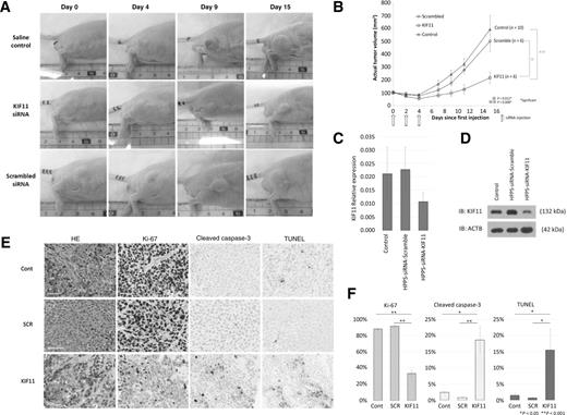 Figure 5. In vivo the knockdown and therapeutic effects of systemic administration of HPPS-chol-si-KIF11 in H460SM xenograft tumor model. A, The representative time-course pictures of each treatment groups. B, H460SM xenograft tumor-bearing mice were systemically administered with saline (n = 10), HPPS-chol-siRNA-scramble (n = 6), and HPPS-chol-siRNA-KIF11 (n = 6), respectively, every other day for a total three doses. Tumor volume was measured from the day of initial treatment (day 0) to at day 15 after treatment, respectively, by blind method. Error bars, SEM. The Student t test (two tailed) was used to determine. Significance and P values less than 0.05 were considered significant (P < 0.05). C, qRT-PCR in each tumor treated with saline control and HPPS-chol-siRNA-scramble, and HPPS-chol-siRNA-KIF11. D, Western blot analysis. E, Ki-67, cleaved caspase-3, and TUNEL staining of the tumors for different groups. F, H460SM tumor sections treated with KIF11 siRNA have reduced proliferation and increased apoptosis as measured by immunostaining of Ki-67, cleaved caspase-3, and TUNEL staining, respectively. Cont, saline control; SCR, HPPS-chol-siRNA-scramble; KIF11, HPPS-chol-siRNA-KIF11.