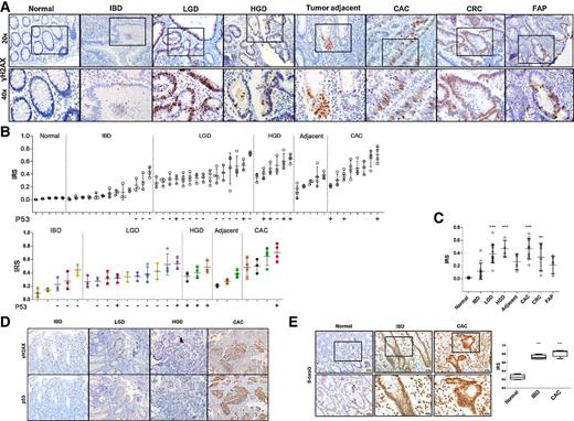 Figure 4. γH2AX as a marker of CIDD in patients with IBD. A, Exemplary pictures of γH2AX staining of human samples (normal, IBD, LGD, HGD, tumor adjacent, CAC, colorectal cancer, FAP) indicating increase of DSBs with disease progression and severity. B, Analysis of patient samples stained for γH2AX; each bar represents a patient; colored bars indicate the same patient with available sequential biopsy and surgical samples. Profound increase of γH2AX-positive nuclei marking DSBs is seen in LGD, HGD, and CAC samples. Below the x-axis, corresponding p53 staining (D) is shown as either – (nuclei p53 negative) or + (nuclei p53 positive). C, Cumulative analysis of γH2AX staining showing significantly higher levels for CAC, HGD, LGD (***, P < 0.001) and colorectal cancer (**, P < 0.01) samples compared with normal mucosa. E, IHC for 8-oxoG in human colon samples from healthy subjects, IBD, and CAC patients, showing overt presence of oxidized DNA damage in IBD and CAC samples. IRS of 8-oxoG levels are significantly increased in IBD (***, P < 0.001) and CAC (***, P < 0.001). Statistical analysis was done with two-sided ANOVA using Dunnet post hoc analysis.