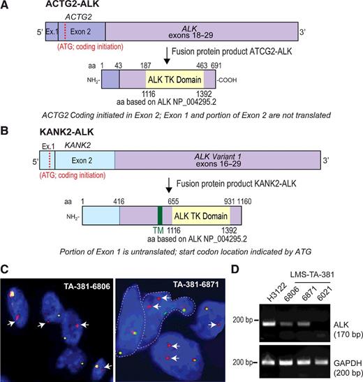 Figure 1. Discovery of ALK fusion genes in leiomyosarcoma. A and B, Domain organization of the novel ACTG2-ALK and KANK2-ALK fusions (top, mRNA; bottom, protein). TM – indicates the transmembrane domain. C, FISH shows chromosomal rearrangement of ALK in two leiomyosarcoma patient samples (TA-381-6806 and TA-381-6871). Both samples were ALK negative by IHC. D, RT-PCR using ALK kinase domain–specific primers demonstrates expression of ALK transcript from TA-381-6806 and 6871 leiomyosarcoma samples, but not from a FISH-negative sample, TA-381-6021 (FISH data not shown). cDNA prepared from H3122, an established EML4-ALK positive lung adenocarcinoma cell line, served as a positive control for ALK expression.