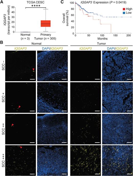 Figure 1. IQGAP3 mRNA expression is highly expressed in human cervical cancer. A Comparison of IQGAP3 expression between the tumor and corresponding normal tissues obtained from the Cervical Squamous Cell Carcinoma TCGA (CESC) dataset. ****, P ≤ 0.0001 (Mann–Whitney test). B, IQGAP3 RNAscope probe was used to target IQGAP3 RNA (yellow dotty signal) on samples of formalin-fixed and paraffin-embedded squamous cell carcinoma (SCC) of the cervix and their paired normal tissues. Note: red blood cells exhibit autofluorescence and appear as bigger corpuscles (red arrowheads). RNAscope signal from normal-appearing epithelia (normal) and tumor areas (tumor) were visually evaluated by a pathologist and given a score (-: negative; +: positive; ++: remarkedly positive; +++: highly positive). Scale bars, 50 μm. C, Kaplan–Meier survival analysis of the CESC dataset. Patients were categorized into groups with high (46 patients) and low (229 patients) expression of IQGAP3. P value from log-rank test.