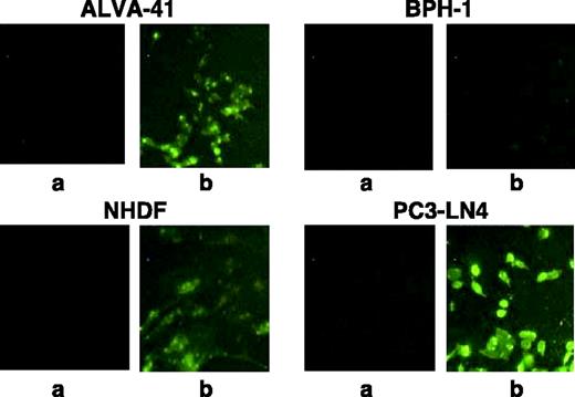 FIGURE 3. Apoptosis inducing activity of antisense CK2α oligodeoxynucleotide toward cancer versus noncancer cells in culture. Cells were grown on a chambered culture slide and treated with 3 μg/mL nonsense (a) or antisense CK2α (b) oligodeoxynucleotide (as phosphorothioate) for 24 hours. N-[1-(2,3-dioleoyloxyl)propyl]-N,N,N-trimethylammoniummethyl sulfate was used as the transfection agent at 1 μg oligodeoxynucleotide/N-[1-(2,3-dioleoyloxyl)propyl]-N,N,N-trimethylammoniummethyl sulfate (5 μL). Cells were fixed in TBS containing 4% paraformaldehyde before TUNEL staining employing In situ Cell Death Detection kit with fluorescein dUTP. Digital fluorescence images were captured using a Zeiss Axiovert microscope system and imported into Adobe Photoshop. Responses of prostate cancer cells PC3-LN4 and ALVA-41, benign prostate epithelial cells BPH-1, and normal human dermal fibroblasts (NHDF). Representative quantitative TUNEL analysis in multiple fields on BPH-1 and PC3-LN4 cells treated with antisense CK2α showed that percentage apoptotic cells in BPH-1 cells treated with antisense CK2α oligodeoxynucleotide was 6.9 ± 1.5 (mean ± SD), whereas it was 80.3 ± 5.6 (mean ± SD) in the PC3-LN4 cells treated with the antisense CK2α under the same conditions.