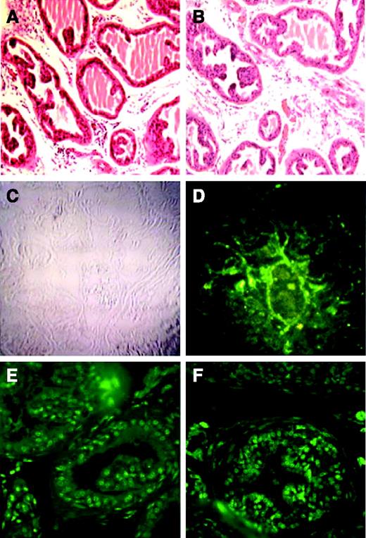 FIGURE 4. Effect of antisense CK2α oligodeoxynucleotide in normal murine prostate. Prostates of mice were injected orthotopically with either 20 μg nonsense oligodeoxynucleotide (control) or 20 μg antisense CK2α oligodeoxynucleotide phosphorothioates (treated) as described in Materials and Methods. Mice were sacrificed at 7 days. Tissue sections of control (A) and treated (B) mice were stained for histology (H&E stain). Note intact glandular architecture in H&E staining of normal prostate treated with antisense CK2α compared with nonsense CK2α. C. Bright-field image of the antisense CK2α-treated murine prostate gland. D. Same section subjected to TUNEL staining showing minimal evidence of apoptosis. E and F. Immunostaining for CK2α in sections of normal murine prostate (E, nonsense oligodeoxynucleotide-treated control; F, antisense CK2α treated as above).