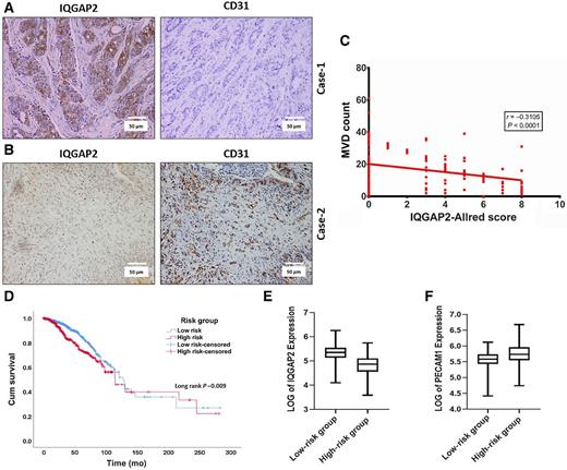 Figure 4. Association of IQGAP2 expression level with MVD (CD31) and survivability in breast cancer. IHC for IQGAP2 and CD31 was carried out in 188 breast tumor tissues. MVD count was analyzed in the vascularized area and expression of IQGAP2 was calculated using the Allred method. A and B, Here, representative IHC images showing the expression of IQGAP2 (left) and CD31 (right) in the tumor region of (A), low-grade breast cancer tissue (Case-1) and (B), high-grade breast cancer tissue (Case-2). The images were taken at ×10 magnification. C, Graph showing a significant negative correlation (Pearson correlation, r = −0.31, n = 188, P < 0.0001) between IQGAP2 and MVD in patients with breast cancer. In the graph, the x-axis indicates the MVD count and the y-axis represents the Allred score of IQGAP2. D, Kaplan–Meier curve for patients with breast cancer (TCGA and BRCA), which were divided into high- and low-risk groups based on median value of the risk scores. IQGAP2 and PECAM1(CD31) expression values were used to get Cox regression coefficients, which were used to calculate risk scores. The x-axis shows survival in months and the y-axis shows probability of overall survival (n = 1,221, Logrank test). E, Box plot visualizes expression of IQGAP2 in the low- and high-risk groups of patients with breast cancer. The x-axis shows risk groups and the y-axis shows log value of IQGAP2 expression (two-tailed unpaired t test). F, Box plot visualizes expression of PECAM1 (CD31) in the low- and high-risk groups of patients with breast cancer. The x-axis shows risk groups and the y-axis shows log value of PECAM1 expression (two-tailed unpaired t test).