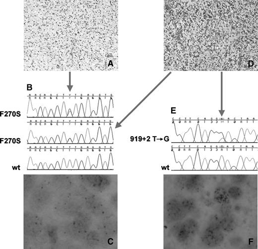 Amplification of KIT, PDGFRA, VEGFR2, and EGFR in Gliomas Molecular