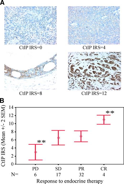 FIGURE 3. Poor clinical response to endocrine therapy is significantly associated with CtIP deficiency in primary breast carcinomas. A. CtIP expression patterns in human breast carcinomas. CtIP expression was evaluated by immunohistochemistry and semiquantified using IRS in 59 inoperable hormone receptor–positive primary breast carcinomas (before treatment) from patients who received endocrine therapy as single neoadjuvant therapy. Representative tumor CtIP immunoreactivity (IRS scores 0, 4, 8, and 12). B. CtIP status strongly correlates with clinical response to endocrine therapy (Pearson correlation, P = 0.004), and patients with progressive disease have significantly lower CtIP IRS than those who completely respond to endocrine therapy. **, P = 0.006 by ANOVA and Tukey's post tests. CR, complete response; PR, partial response; SD, stable disease; and PD, progressive disease.