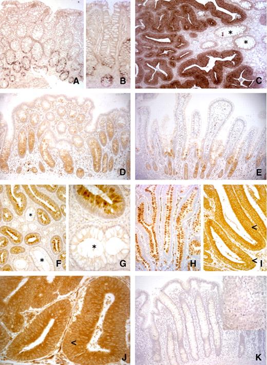 FIGURE 4. Expression of KIAA1199 mRNA and protein in normal intestinal mucosa and colorectal tumors. In situ hybridization studies (A-C) localized KIAA1199 mRNA expression to the lower portion of normal epithelial crypts (A and B) and revealed that expression is markedly up-regulated in colorectal tumors (C). Asterisk, note the different levels of expression in tumor glands and normal crypts. D. KIAA1199 protein expression is also limited to the lower half of the normal colonic crypts, and a similar pattern is observed in the ileal mucosa (E), where the protein is expressed only in the crypts (not in the villi). In F and G, adenomatous crypts with low-grade dysplasia present increased expression of KIAA1199, particularly in the cytoplasm facing the crypt lumen, and in and around the mucin vacuoles of goblet cells (note the striking difference with goblet cells of normal crypts in both panels). The expression pattern changes dramatically during the transition from low-grade dysplasia with goblet cell differentiation (H) to high-grade dysplasia in which this differentiation is no longer apparent. J. In more advanced colon tumors, KIAA1199 overexpression is maintained. Note that, in I and J, the expression of KIAA1199 protein (like that of KIAA1199 mRNA; C) is highest in the luminal portion of the dysplastic glands (arrowheads, multilayer of unstained nuclei occupying more than the basal half of the dysplastic epithelium). K. Normal mucosa, with the corresponding tumor in the inset. Negative control: KIAA1199 antibody preabsorbed with the peptide used to immunize rabbits.