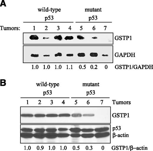 FIGURE 4. Relationship between p53 mutational status and GSTP1 expression in brain tumor cells. Seven early-passage cultures of human gliomas were used in these studies. A. Higher GSTP1 transcript levels in brain tumor cells with wild-type p53. GSTP1 gene transcript levels were examined by Northern blotting and relative GSTP1 expression (GSTP1/GAPDH) was determined using MGR3 as standard. B. Increased GSTP1 protein expression in brain tumor cells correlates with the presence of wild-type p53. Levels of GSTP1 and p53 proteins were determined by Western blotting. Relative GSTP1 levels are expressed as GSTP1/β-actin with MGR3 as expression standard.