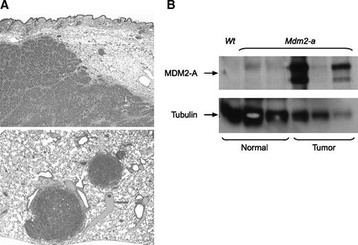 FIGURE 6. Mdm2-a/p53-heterozygous mice develop aggressive mammary tumors, which have stabilized MDM2-A expression. A.Micrographs of Mdm2-a/p53-heterozygous mammary carcinomas. Top, mammary carcinoma with soft tissue invasion. Magnification, ×4. Bottom, mammary carcinoma metastases in the lung parenchyma. Magnification, ×3.2. B. Western blot analysis of MDM2-A expression in normal mammary tissue (lanes 1-3) and mammary tumor tissue (lanes 4-6) isolated from p53-heterozygous (lane 1) and Mdm2-a/p53-heterozygous transgenic mice (lanes 2-6).