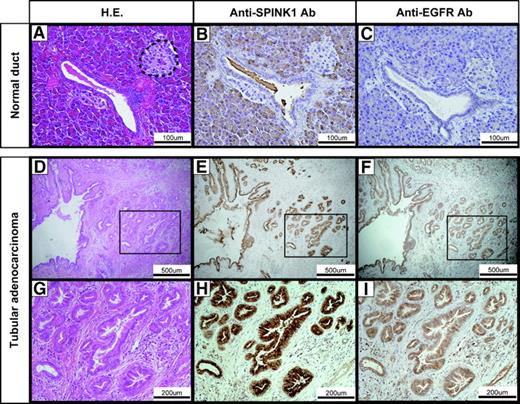 FIGURE 5. Expression of SPINK1 and EGFR in pancreatic tubular adenocarcinoma. A. H&E staining of normal pancreas. Area surrounded by a dotted line shows the islet. B. Normal pancreas showing expression of SPINK1 in acinar cells but not in pancreatic islet and normal pancreatic duct. C. Normal pancreas showing no EGFR expression in any type of cells. D and G. H&E staining of pancreatic tubular adenocarcinoma. E and H. Expression of SPINK1 in pancreatic tubular adenocarcinoma. F and I. Expression of EGFR in pancreatic tubular adenocarcinoma. G to I. Higher magnification of areas indicated in D to F.