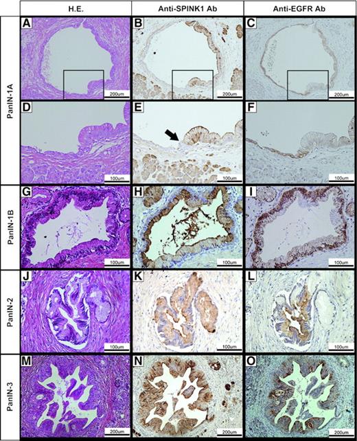 FIGURE 6. Expression of SPINK1 and EGFR in PanIN lesions. A. H&E staining of PanIN-1A. B. Expression of SPINK1 in PanIN-1A region. Note that SPINK1 was not expressed in normal epithelial cells. Arrow, boundary of normal duct and PanIN-1A. C. Expression of EGFR in PanIN-1A and normal epithelial cells. D to F. Higher magnification of areas indicated in A to C. G. H&E staining of PanIN-1B. H. Expression of SPINK1 in PanIN-1B region. I. Expression of EGFR in PanIN-1B region. J. H&E staining of PanIN-2. K. Expression of SPINK1 in PanIN-2 region. L. Expression of EGFR in PanIN-2 region. M. H&E staining of PanIN-3. N. Expression of SPINK1 in PanIN-3 region. O. Expression of EGFR in PanIN-3 region.