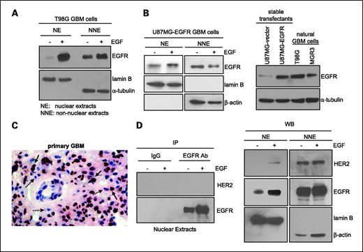 FIGURE 1. EGFR undergoes nuclear translocalization in human GBM cell lines and primary specimens. A, EGF induces EGFR nuclear transport in GBM cells with endogenous EGFR. Serum-starved human GBM T98G cells that express endogenous EGFR were stimulated with EGF (100 ng/mL) for 0 and 15 min, harvested, and subjected to nuclear fractionation to obtain nuclear extracts (NE) and nonnuclear extracts (NNE). Both extracts were analyzed for EGFR, lamin B, and α-tubulin expression through Western blotting. Effectiveness of fractionation is indicated by the lack of cytoplasmic marker α-tubulin in nuclear extract and the absence of nuclear protein lamin B in nonnuclear extract. B, EGFR undergoes EGF-activated nuclear transport in GBM cells engineered to stably express EGFR. Left, U87MG-EGFR stable transfectant cells were similarly treated and analyzed as described. Right, Western blotting shows U87MG-EGFR cells to express EGFR at the levels comparable with natural T98G and MGR3 GBM cells that express endogenous EGFR. C, nuclear EGFR is detected in a primary GBM specimen. We analyzed 12 primary GBM tumors for EGFR expression using IHC and found 6 tumors to express EGFR/EGFRvIII with one of them expressing significant levels of nuclear EGFR. Solid arrows, EGFR-positive brown nuclei; dashed arrows, EGFR-negative blue counterparts. D, nuclear EGFR is not in complex with nuclear HER2 in T98G cells. Using T98G GBM cells know to express both EGFR and HER2, we treated the cells with EGF for 0 and 15 min, fractionated the cells into the nuclear and nonnuclear fractions, immunoprecipitated nuclear EGFR using an EGFR antibody, and subjected the immunoprecipitates to Western blotting to detect HER2. As shown in the left, HER2 was not coimmunoprecipitated with nuclear EGFR despite nuclear EGFR was effectively immunoprecipitated by the EGFR antibody. IgG did not pull down EGFR or HER2, indicating specificity. As shown by the Western blotting in the right, HER2 underwent a modest level of nuclear translocalization after EGF stimulation with the majority of the HER2 protein in the nonnuclear fraction.