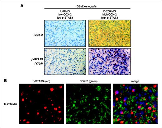 FIGURE 6. Increased COX-2 expression is detected in GBM xenografts with EGFR/EGFRvIII and activated STAT3. A, COX-2 is highly expressed in GBM xenografts with highly activated STAT3. Two GBM xenografts were analyzed for levels of COX-2 and p-STAT3 (Y705) through IHC. The D-256 MG GBM xenograft but not the U87MG xenograft expressed high levels of COX-2 and p-STAT3. Brown signals, p-STAT3-positive nuclei; blue, negatively stained nuclei. B, the majority of p-STAT3–expressing GBM cells in the D-256 MG xenograft express COX-2. The D-256 MG GBM xenograft was analyzed for the coexpression of p-STAT3 and COX-2 using double fluorescence staining–coupled IHC. Red fluorescence, p-STAT3. Green fluorescence, COX-2. Nuclei, blue. p-STAT3–positive nuclei, pink signals as merged products of red and blue fluorescence. The majority of p-STAT3–positive nuclei expressed high levels of COX-2. COX-2 is also expressed in cells without significant p-STAT3 expression, suggesting that p-STAT3–independent mechanisms may account for the transcriptional activation of the COX-2 gene in these cells.