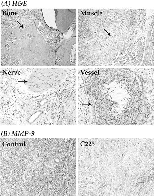 Fig. 3. A, histological sectioning of tumors growing in the floor of the mouth region in the orthotopic mouse model system. SCC-1 cells demonstrate capacity for locoregional invasion into surrounding tissues including bone, muscle, nerve, and vessel as indicated by arrows. Photographs are taken from representative tissue sections stained with H&E. B, effect of C225 on the expression of MMP-9. Immunohistochemical staining of MMP-9 was determined using human SCC-1 tumor sections taken from control or C225-treated mice. Positive (brown) staining indicates the expression of MMP-9. Photographs show representative tissue sections from the control and the treatment group, respectively (a total of three sections were stained per group).