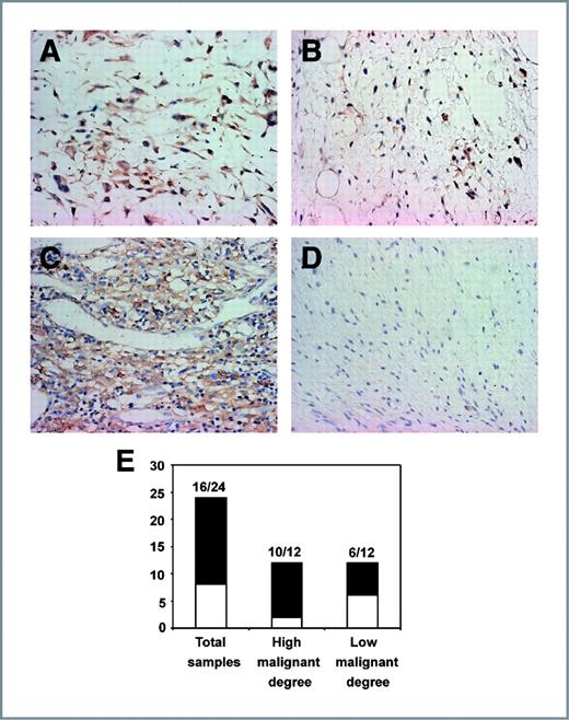 Figure 6. Elevated expression of SERCA2 is related to the malignant degree of different types of human liposarcoma. Immunohistochemical staining assay was carried out for SERCA2 by using human liposarcoma samples. Paraffin sections of human liposarcoma tissues were collected from 24 patients who had undergone surgical resection for liposarcoma between 2008 and 2009. A, pleomophic liposarcoma, B, round cell liposarcoma, C, dedifferentiated liposarcoma, D, well-differentiated liposarcoma. E, the percentages of SERCA2 positive samples in groups with different malignant degrees.