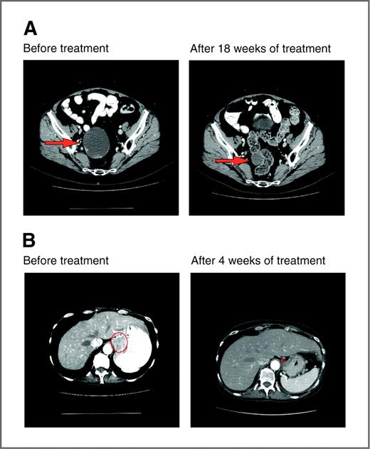 Figure 2. Computed tomography scans of responding patients. A, patient with endometrial cancer demonstrating partial response in pelvic mass. B, patient with squamous cell cervical cancer demonstrating partial response in gastrohepatic metastasis. Arrows or circles, locations of metastases