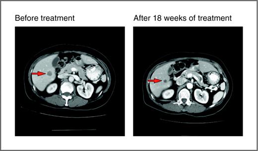Figure 3. Computed tomography scans of responding patients. Patient with endometrial cancer demonstrating partial response in liver metastases. Arrows, locations of metastases.