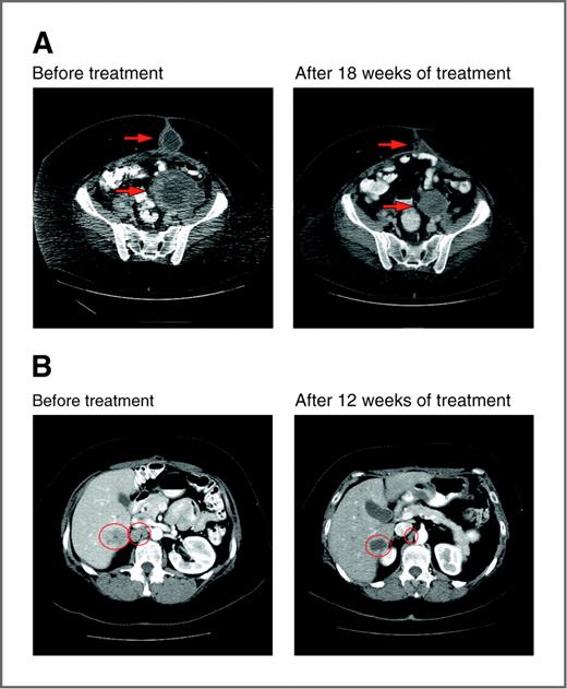 Figure 4. Computed tomography scans of responding patients. A, patient with ovarian cancer demonstrating partial response in pelvic and subcutaneous metastases. B, patient with ovarian cancer demonstrating partial response in liver and aortocaval metastases. Arrows or circles, locations of metastases.