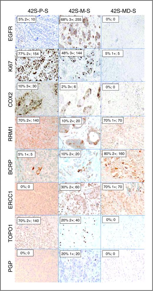 Figure 2. Immunohistochemical detection of biomarkers evaluated in this study. Representative photomicrographs from IHC staining for the indicated markers in specimens obtained from the primary peritoneal specimen (42S-P-S) and 2 recurrences in the omentum (42S-M-S) and breast (42S-MD-S) of patient 42S. Inset boxes, pathology assessment: percentage of positive tumor cells and intensity of staining (0–3+); histoscore (0–300).
