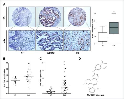 Figure 1. AURKA is significantly amplified and overexpressed in esophageal adenocarcinoma tissues. A, representative images of AURKA immunostaining in tumor (esophageal adenocarcinomas; EAC) and histologically normal nontumor (NT) tissue samples are shown at ×20 and ×40. The immunohistochemical analysis of AURKA protein expression showed significant overexpression of AURKA in 70% of esophageal adenocarcinomas (average CES: 6.7 ± 0.28). **, P < 0.001. MD, moderately differentiated; PD, poorly differentiated; WD, well differentiated. B, qPCR analysis of AURKA DNA in normal esophageal (n = 14) and esophageal adenocarcinomas (n = 34) tissue samples shows frequent DNA amplification (≥1.5-fold) in esophageal adenocarcinomas (44.1%) tissues. C, qRT-PCR analysis of AURKA mRNA in normal esophageal (n = 23) and esophageal adenocarcinomas (n = 44) tissue samples show frequent mRNA overexpression (≥2.0-fold) in esophageal adenocarcinomas (84.1%) tissues samples. D, chemical structure of MLN8237 (Millennium Pharmaceuticals, Inc.).