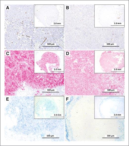 Figure 6. Immunohistochemical staining of KPL-4 tumor sections for the MECA-32 vascular endothelium marker (brown; A, B), HER2 receptors (pink; C, D), and bound trastuzumab (blue; E, F). Images in A, C, and E correspond to trastuzumab (17 mg/kg) only treated mice, whereas those in B, D, and F are derived from mice receiving a single anti-VEGF dose (10 mg/kg) 24 hours before trastuzumab. Tumors were harvested at 24 hours after intravenous administration of trastuzumab. Scale bar, 500 μm. Insets display same tumor sections at a larger scale (2.0 mm).